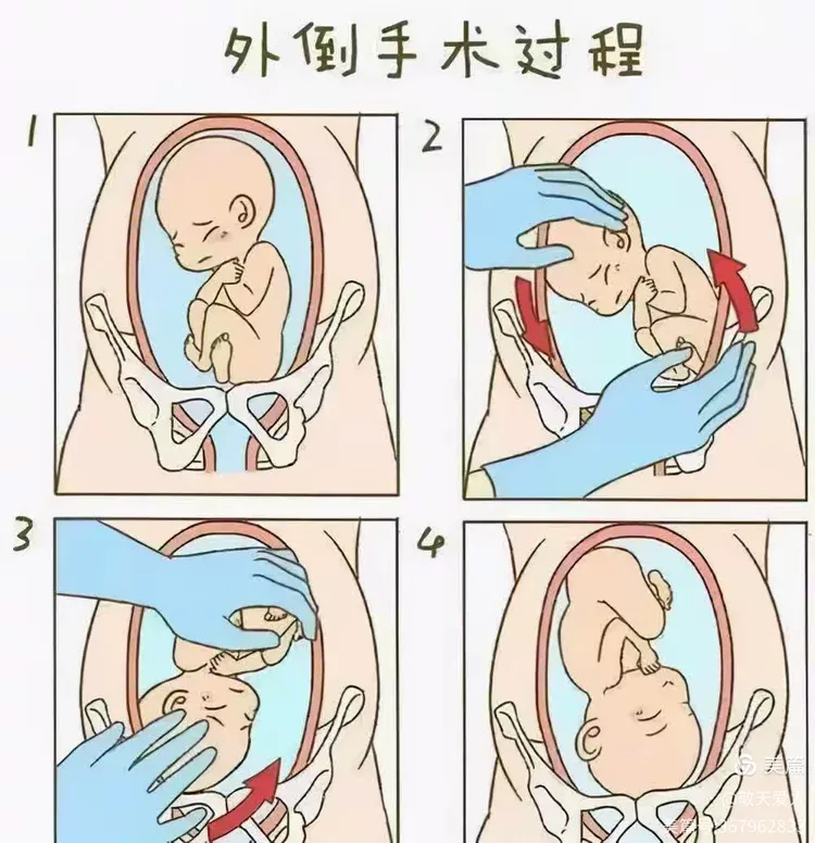 任丘市人民医院乾坤大挪移术（外倒转术）科普知识！！！